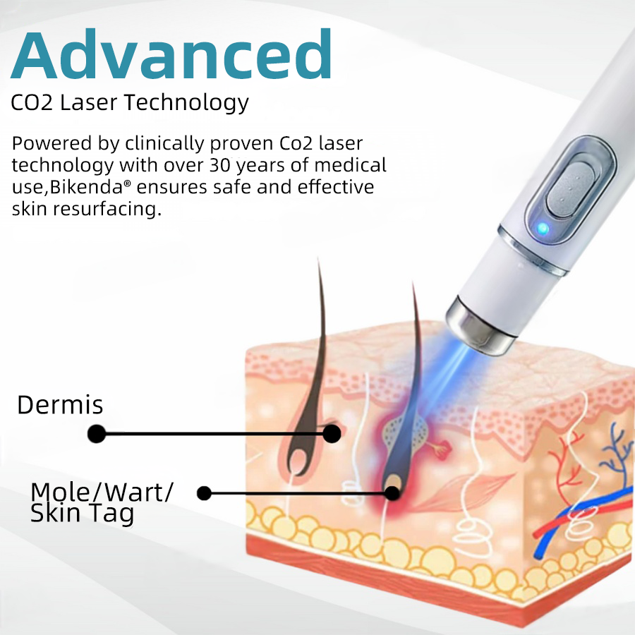 Vermoila® Non-Invasive Mole and Wart Removal Laser Pen Promax