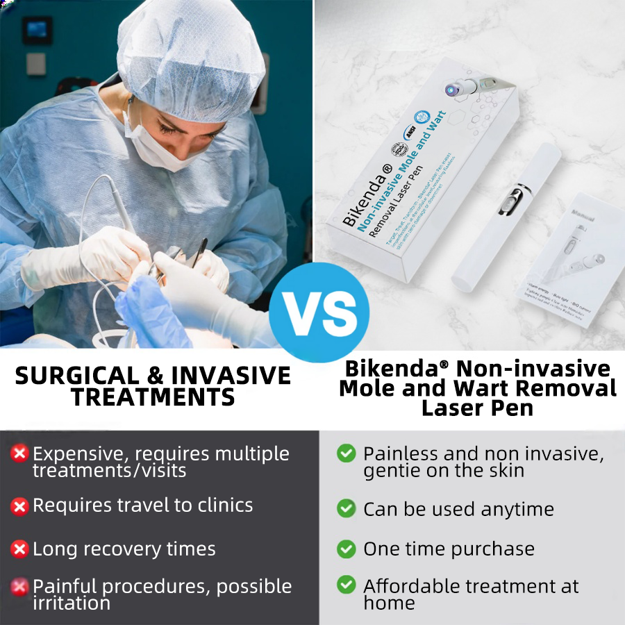 Vermoila® Non-Invasive Mole and Wart Removal Laser Pen Promax