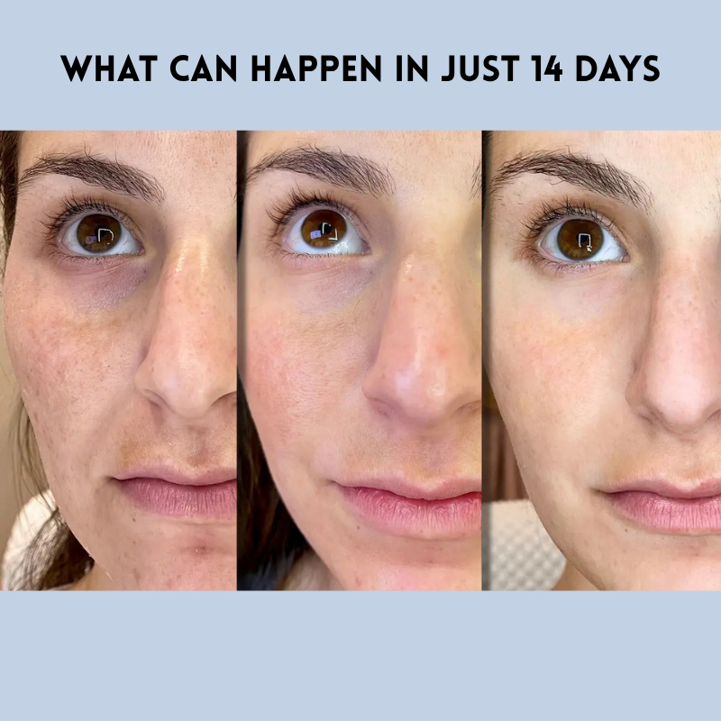 YouthLift Renew Strips – The Instant Solution for Timeless Beauty