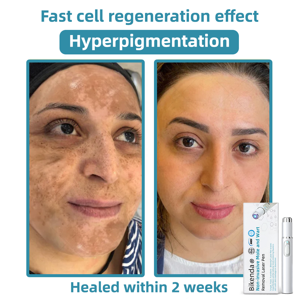 Vermoila® Non-Invasive Mole and Wart Removal Laser Pen Promax