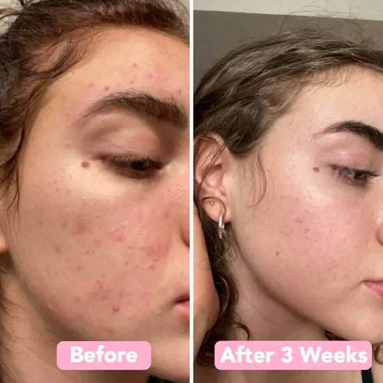 Fade Dark Spots Fast – Velleara Turmeric & Kojic Acid Pads