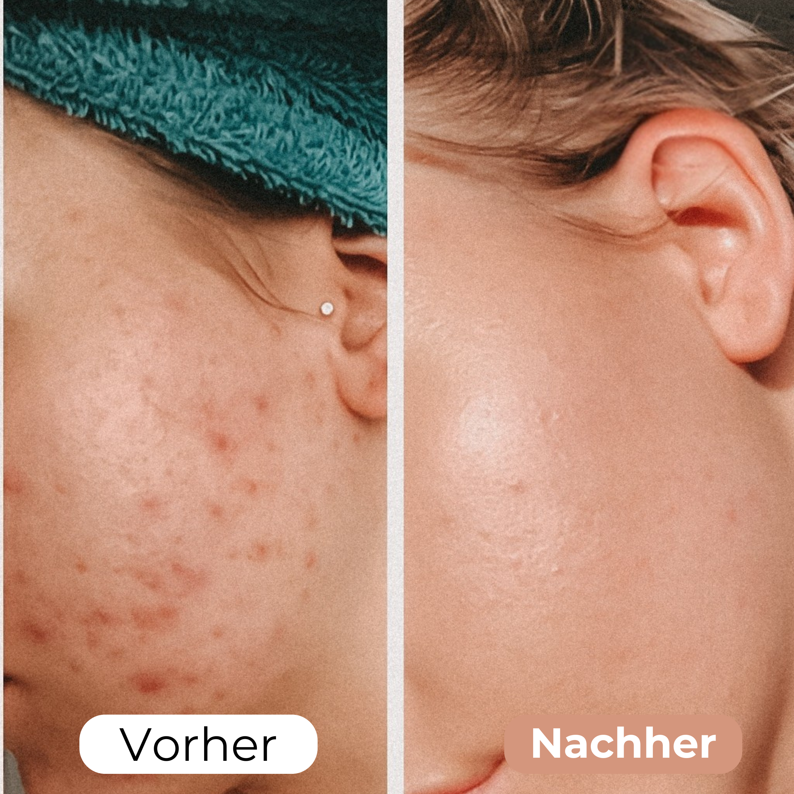 WrinkleAway™ Hydrated Wrinkle Reduction
